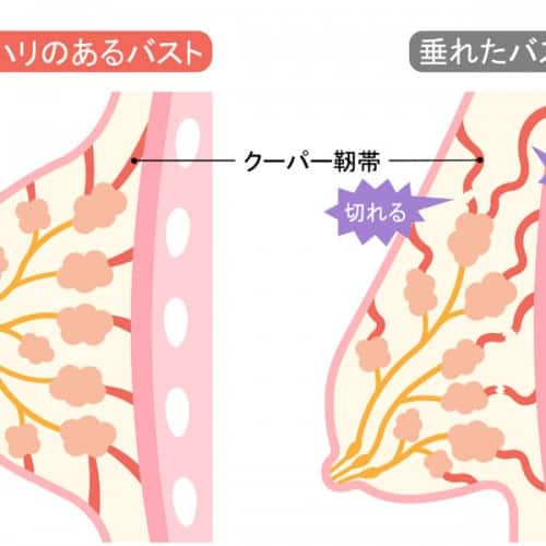 バストの下垂はクーパー靭帯のせいなの？