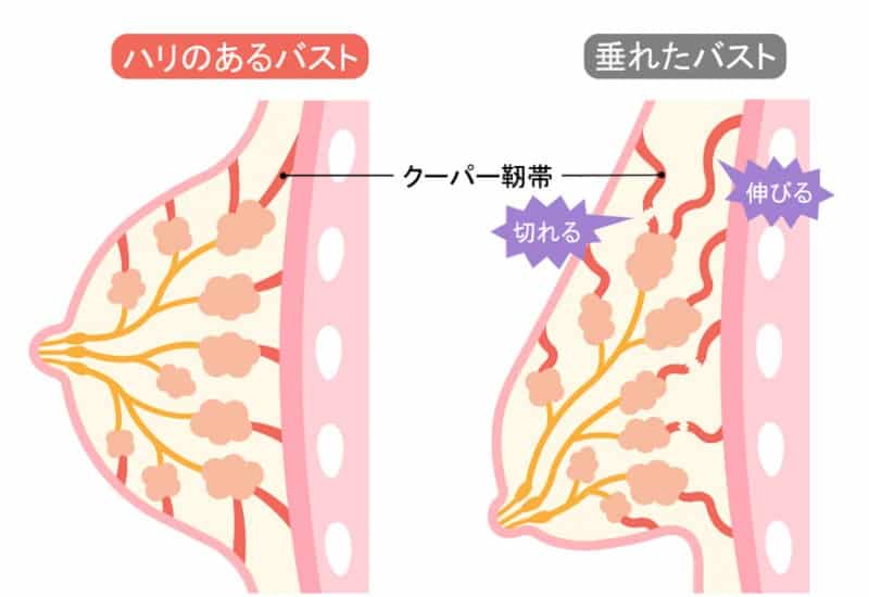 バストの下垂はクーパー靭帯のせいなの？