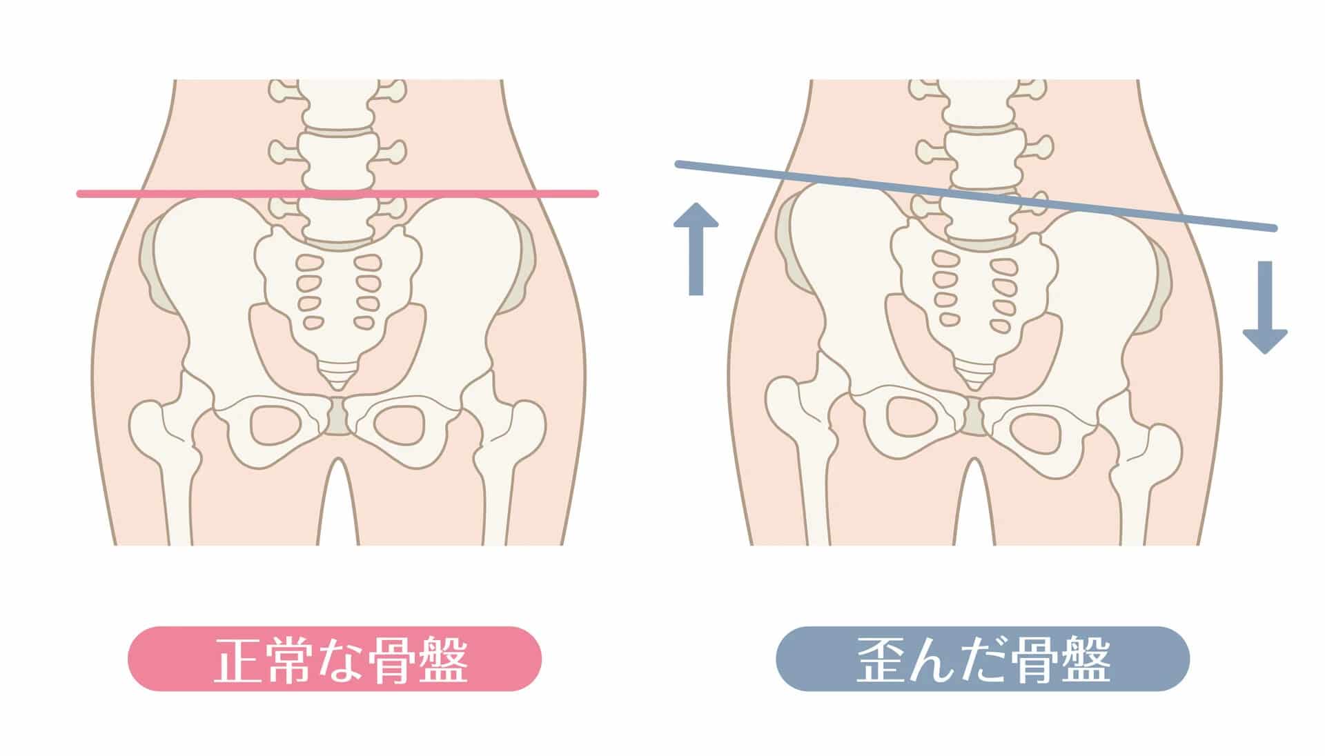 骨格の歪み